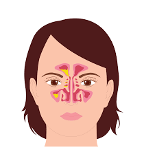 Bijholteontsteking zonder verkoudheid: hoe kan dat?