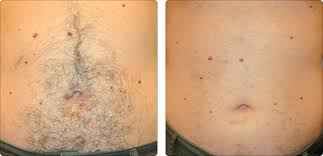 Ingrown hair brazilian laser hair removal before and after photos. Laser Hair Removal Hayes Valley Medical Esthetics
