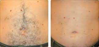 Ingrown hair brazilian laser hair removal before and after photos. Laser Hair Removal Hayes Valley Medical Esthetics