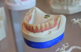 Plus, with today's technology, dentures can make your smile look natural and beautiful. What Is Partial Dentures How Much Does It Cost Natural Smiles