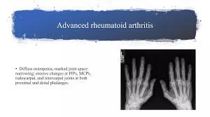 Image result for XRay Changes in Rheumatic Conditions
