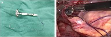 A 58 year old man with long standing barretts oesophagus is found to have a nodule on endoscopic surveillence. Modified Reverse Puncture Anastomotic Technique Vs Traditional Technique For Total Minimally Invasive Ivor Lewis Esophagectomy World Journal Of Surgical Oncology Full Text