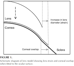 Si tratta di un prodotto consigliato. Parametri Di Lenti A Contatto Morbide Per Un Applicazione Efficace Secondo Un Modello Teorico Societa Optometrica Italiana