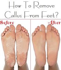 How To Remove Callus From Feet Callus Removal Foot Remedies Callus Remover Diy