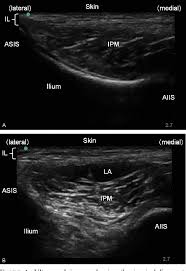Lateral femoral cutaneous nerve ultrasound. Ultrasound Guided Lateral Femoral Cutaneous Nerve Block Comparison Of Two Techniques Semantic Scholar