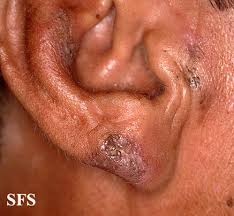 The comedones are widened openings for hair follicles and sebaceous glands filled with material. File Favre Racouchot Syndrome 05 Jpeg Wikidoc
