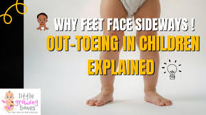 Image result for Out-toeing