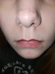 My Nose Will Not Stop Peeling Skincareaddicts