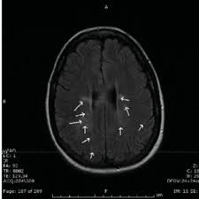 O diagnóstico é baseado em critérios clínicos e exames de imagem por ressonância magnética do cérebro e medula espinhal. Pdf Esclerose Multipla Duas Apresentacoes Clinicas Uma So Doenca