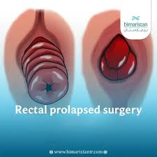 Image result for Rectal prolapse