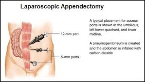 It's rich in vitamin c and fibre, which are known to lower the risk of diabetes. Appendicitis Physiopedia