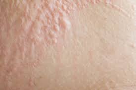 9 leukemia rashes, bruises, and other skin manifestations. Leukaemia Cutis Leukaemia Care