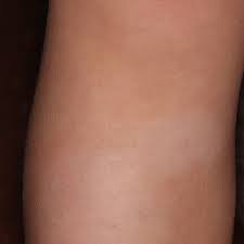 Check spelling or type a new query. Pityriasis Alba Altmeyers Enzyklopadie Fachbereich Dermatologie