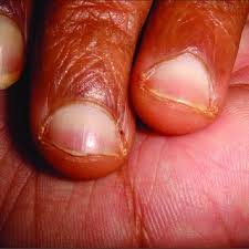 These are the diseases we'll discuss in this lecture. Pdf Cutaneous Manifestations Of Chronic Kidney Disease Dialysis And Post Renal Transplant A Review