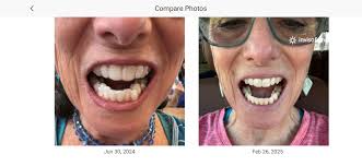 Invisalign treatment progress update