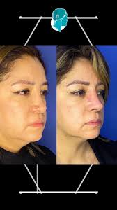 😱 ¡El cambio es real!, Así luce el antes y después de una rinoseptoplastia  que no solo mejoró su nariz... ¡también su respiración y calidad de vida!  👃💨, 🔍 Resultado natural, 💯 Sin dolor excesivo, 💤 ...