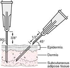 Subcutaneous Injection Definition Of Subcutaneous Injection By Medical Dictionary Intravenous Injection Subcutaneous Injection Medical Dictionary