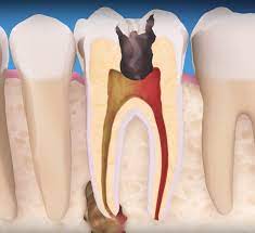 Root Canal Therapy To Rescue Your Teeth Dentalopolis Spring Tx