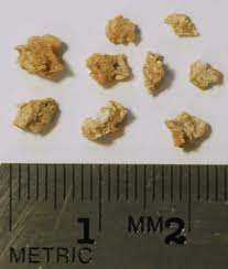 How To Treat Kidney Stones With Diet Nutrition For A Lifetime