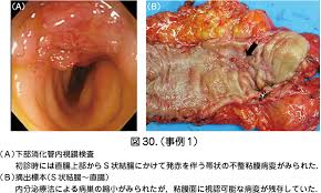 5）稀少部位子宮内膜症の取り扱い – 日本産婦人科医会