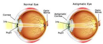 You may be given medicine to help you relax. Lasik Astigmatism Explore Your Options Qualsight Lasik