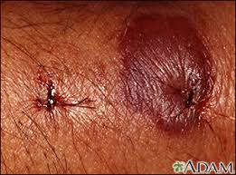 Bug Bite With Black And Blue Ring Around It Insect Bites And Stings Penn State Hershey Medical Center