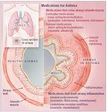 In This Week S Jama Patient Page We Discuss Medications Used To Treat Asthma Learn More Http Ja Ma 2hdplwz Asthma Treatment Medical Asthma
