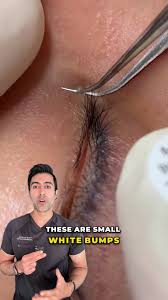 Image result for milium cyst on eyelid