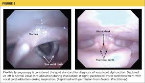 Image result for Vocal Cord Dysfunction