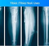Tibial (Tibia) Nail Specification, Uses, Sizes & Surgical ...