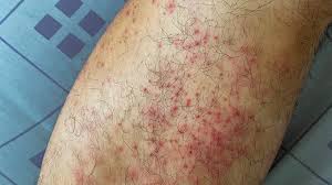 Image result for Papular urticaria