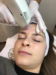 Tixel® is a treatment using fractional thermomechanical ablative technology to tighte.n the skin, iron out wrinkles , improve the appearance of scars and reduce pores. Tixel Behandlung Gegen Falten Und Aknenarben Erfahrungsbericht
