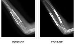 Forearm Plates - Upper Extremity Fracture Fixation - TriMed Inc.
