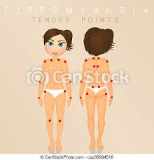 Fibromyalgia is known for painful tender points throughout the body. Tender Points Of Fibromyalgia Illustration Of Tender Points Of Fibromyalgia Canstock
