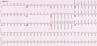 Ecg Ekg Examples And Quiz Oxford Medical Education