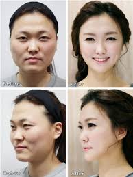 Patient Testimonials Plastic Surgery Korean Plastic Surgery Plastic Surgery Photos