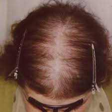 Ursachen Haarverlust Haarsprechstunde