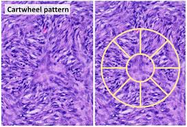 Image result for Dermatofibrosarcoma Protuberans