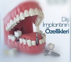 Dis Implanti Cekilen Ya Da Herhangi Bir Nedenle Kayba Ugrayan Dislerin Yerine Cene Kemigi Icerisine Yerlestirilen Titanyum Esasli Bir Pa Dis Dis Sagligi Yerler