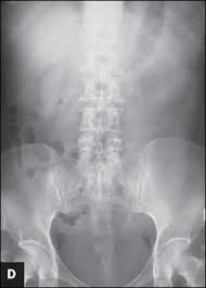 If you develop a fever or chills, contact your doctor. Middle Aged Woman With Bilateral Staghorn Calculi Consultant360