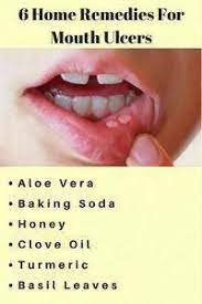 Six Home Remedies For Mouth Ulcers Naturaloralcare Whatisprimaryoralhealthcare Whatisanoralhealthc Ulcer Remedies Mouth Mouth Ulcers Mouth Ulcer Home Remedy