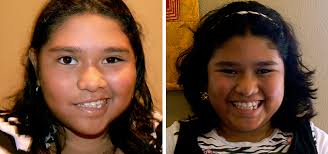 The extent of nerve damage determines the extent of recovery. Bell S Palsy Aimc