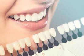 Porcelain Veneers Mandurah Platinum Smile Dentist Mandurah