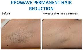 It uses a proprietary system called ehpl, or flashes of intense pulsed light (ipl) combined with galvanic energy. Ipl Hair Removal Reviews Off 63 Online Shopping Site For Fashion Lifestyle