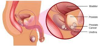 Check spelling or type a new query. Prostate Cancer The Silent Killer Of Men Redcare