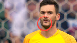 Finde hier das gehalt von loris karius: Tierische Abwehr Von Lloris Insekten Attacke Auf Frankreich Torwart Fifa Wm 2018 Bild De