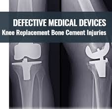 Knee Replacement Bone Cement Injuries Mrsb