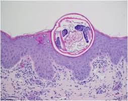 Image result for scabies on genitals