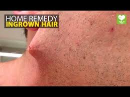 It's sometimes used to treat acne, and it may also work for ingrown hairs. Home Remedies To Expose Ingrown Hair Health Care Education Youtube