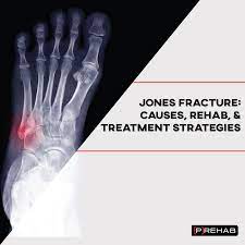 Jones Fracture Exercises And Treatment Strategies | [P]Rehab